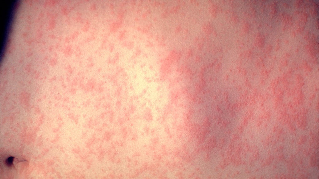 25 cases of measles identified in central, southeastern Minnesota, MDH says — WCCO / CBS Minnesota, Roseville Health news